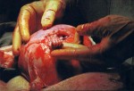 This photo shows a 21-week-old pre-born baby who was being operated on by a surgeon named Joseph Bruner (his finger is in the photo). Baby Samuel had been diagnosed with Spina Bifida. The operation was held at Vanderbilt University Medical Center in Nashville, TN. The doctor and his team pioneered the delicate operation in an attempt to save little Samuel's life. As the doctor probed the opening, little Samuel reached out and wrapped his little tiny hand around the surgeon's finger! The surgery was a success and Samuel was born on Dec. 2, 2000, weighing 5 lbs. 22 ozs., measuring 20-1/2 inches long. He was born at 36 weeks.
